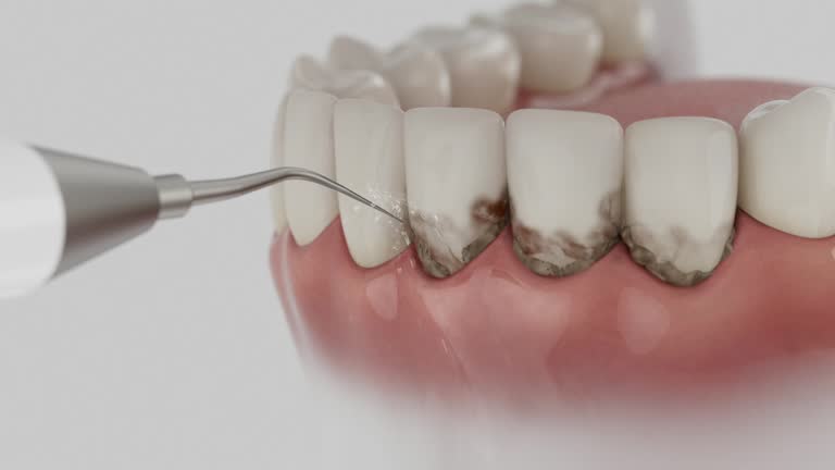 Trusted Tooth Extraction service in Centerville, UT - Dentist Open Now